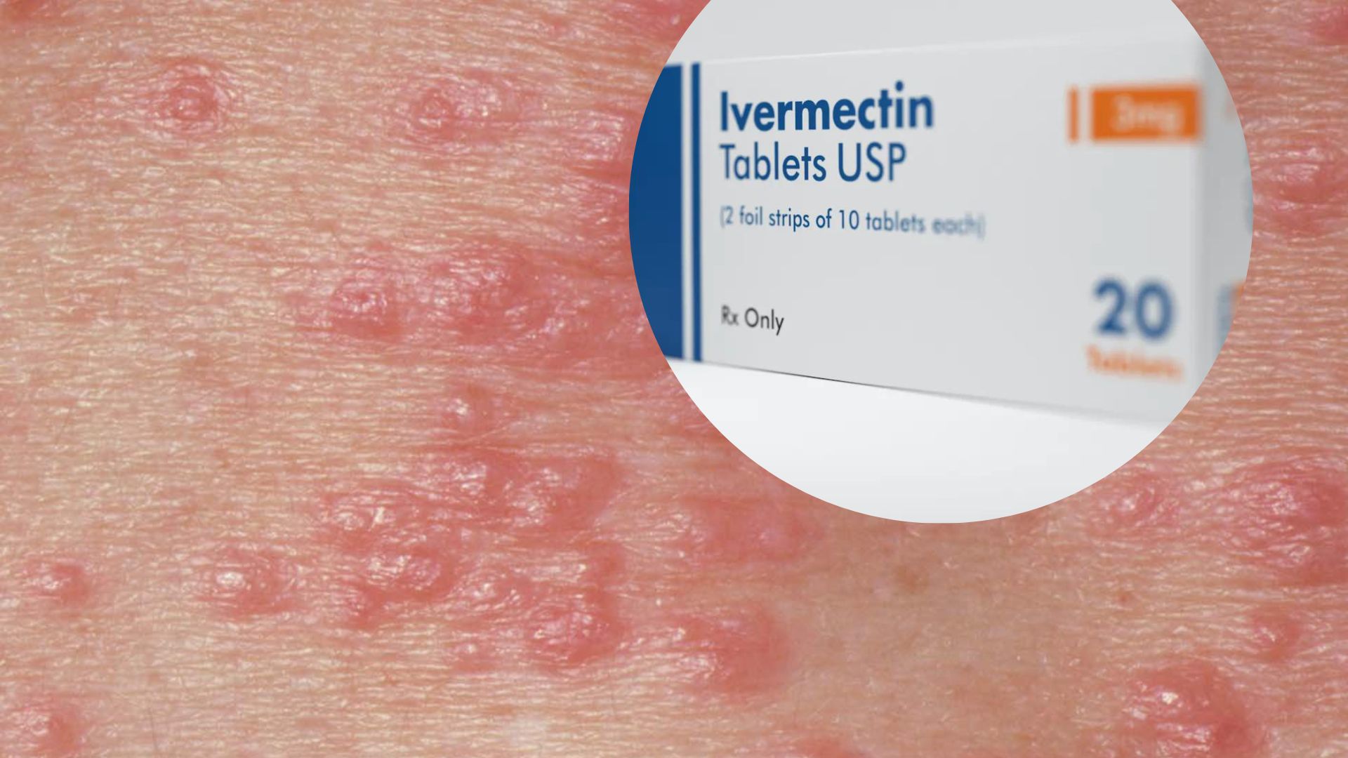 Scabies Medicine Available Again After Patients Left Waiting For Months 